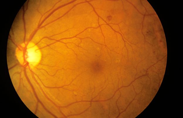 Fundus camera image showing the blood vessels of the retina of a person suffering from diabetes
